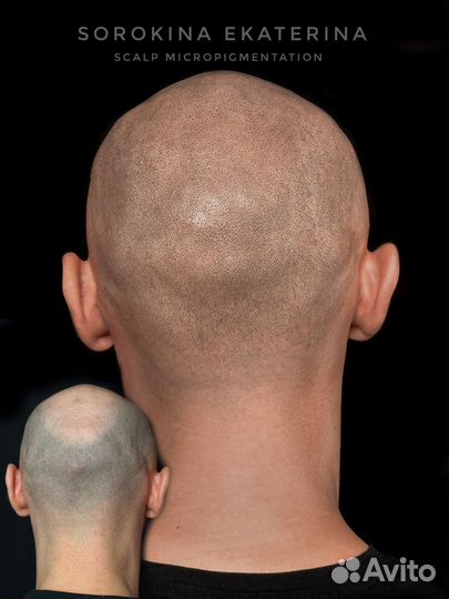 Трихопигментация головы