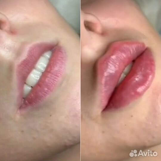 Увеличение губ