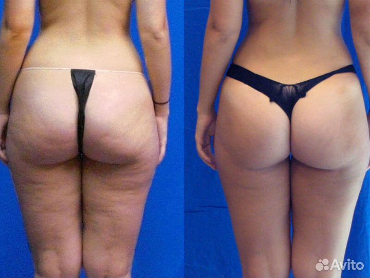 LPG массаж тела. Гуаша. Качественно. В центре