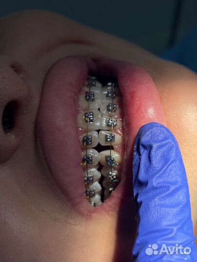 Брекеты установка