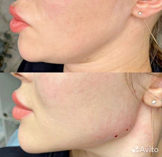 Лицо под ключ, Фулл Фейс, Овал Джоли