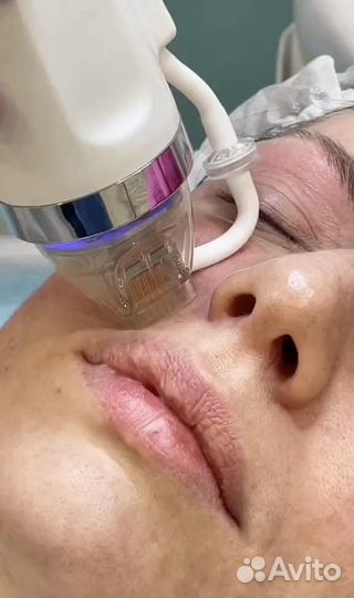 Игольчатый RF лифтинг