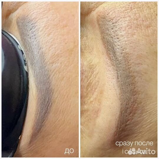 Модель на Удаление тату / Перманентного макияжа