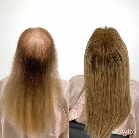 Система замещения волос, накладка hair talk