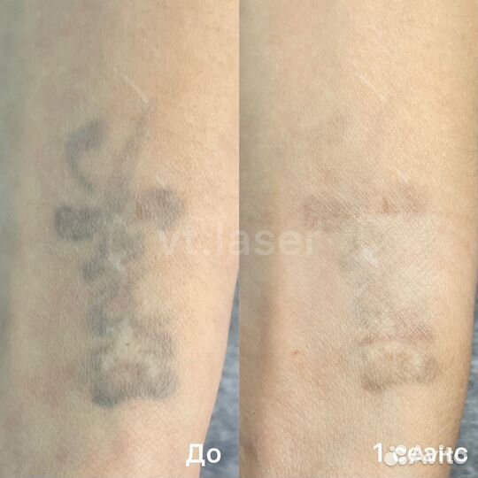 Лазерное удаление тату и татуажа