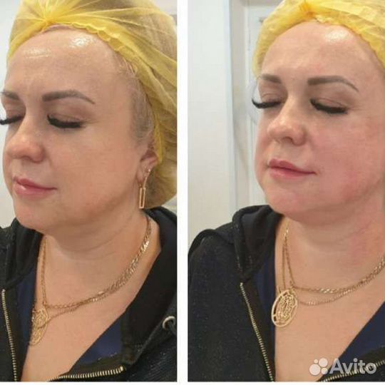 Смас лифтинг безьоперационная подтяжка