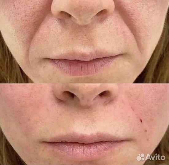 Коррекция носогубных морщин