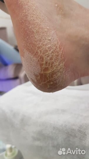 Средство для удаления натоптышей и мазолей