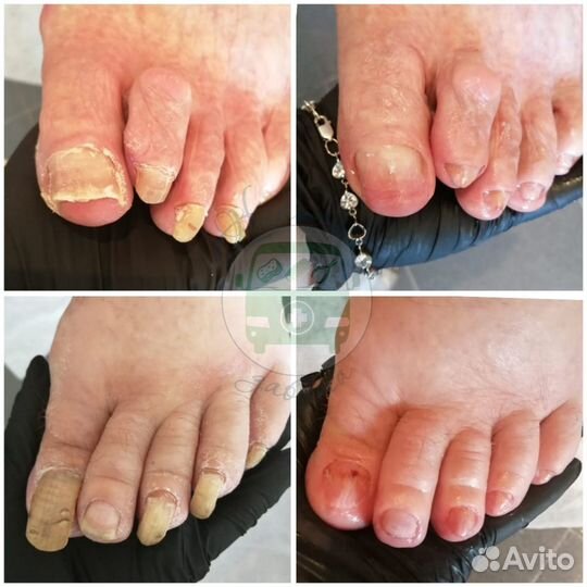 Подолог,медицинский педикюр,педикюр пожилым. Выезд