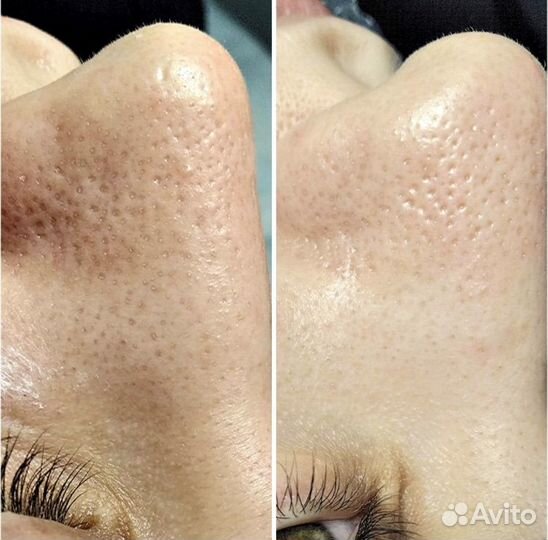 Чистка лица дома