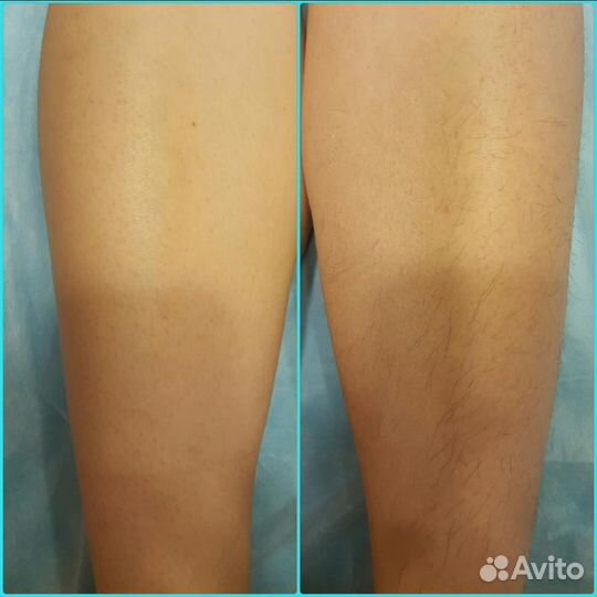 Восковая депиляция и шугаринг