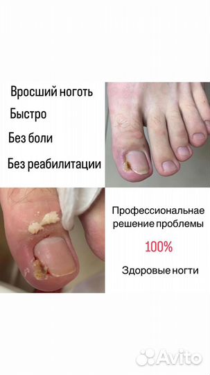 Медицинский педикюр подолог