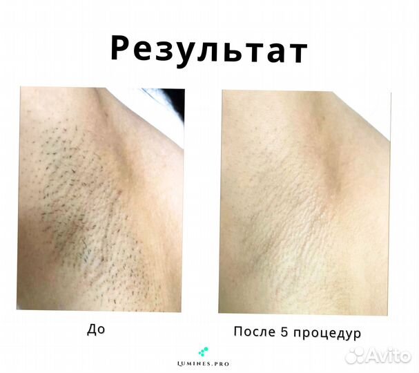 Аппарат для эпиляции Lumines Макс-Ван 1200