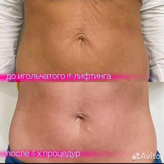 Микроигольчатый rf-лифтинг