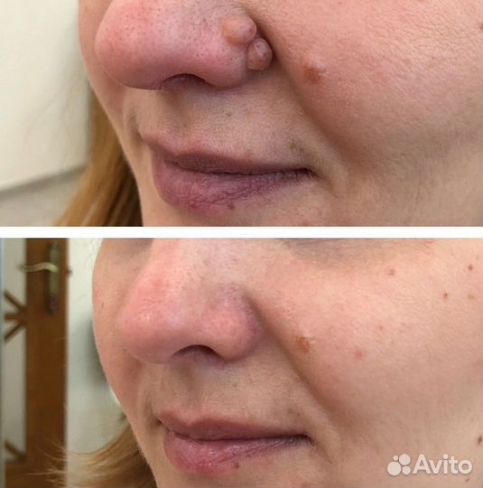 Удaление папиллoм, бородавок, новоoбрaзовaний