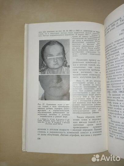 Отдаленные последствия лучевой терапии у детей. 19