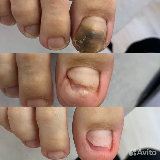 Лазерное лечение грибка ногтей и кожи