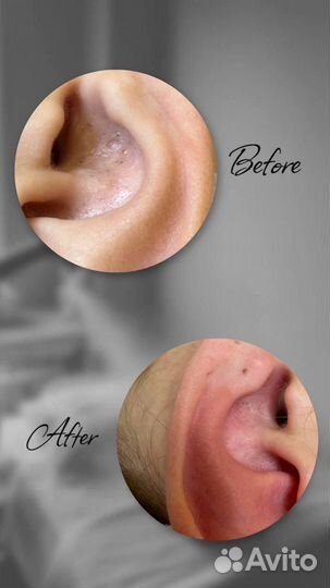 Комбинированная чистка лица