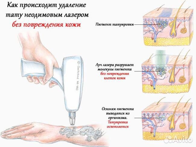 Лазерное удаление тату и татуажа