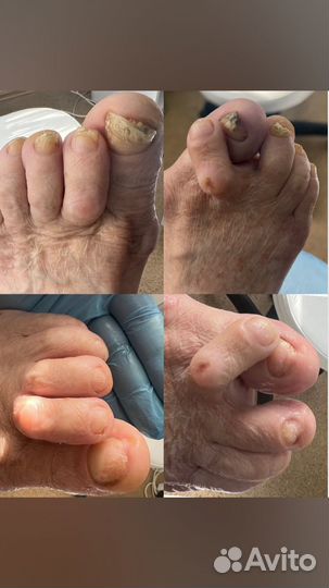 Подологический педикюр