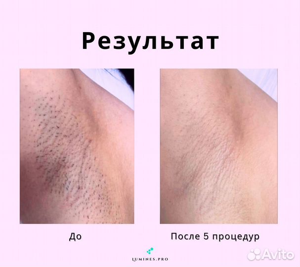 Диодный лазер Лю’минес Max One 1200в