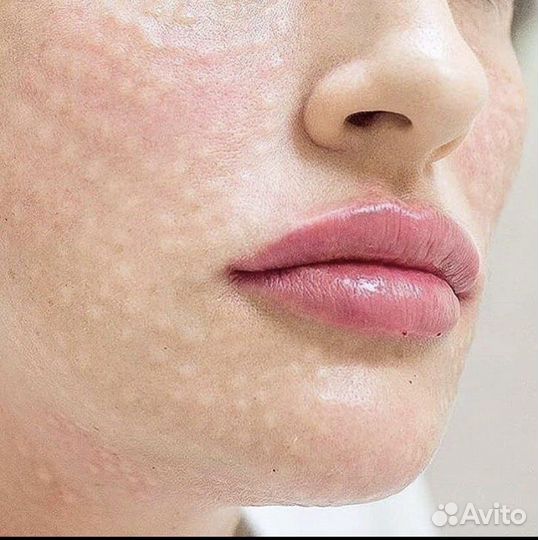 Биоревитализация