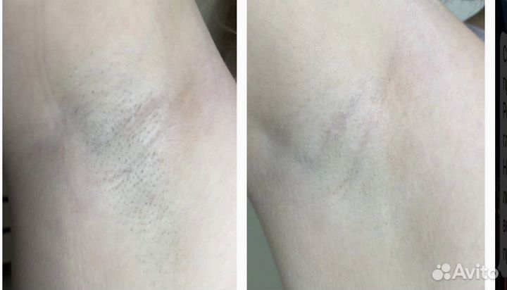 Эпиляция elos