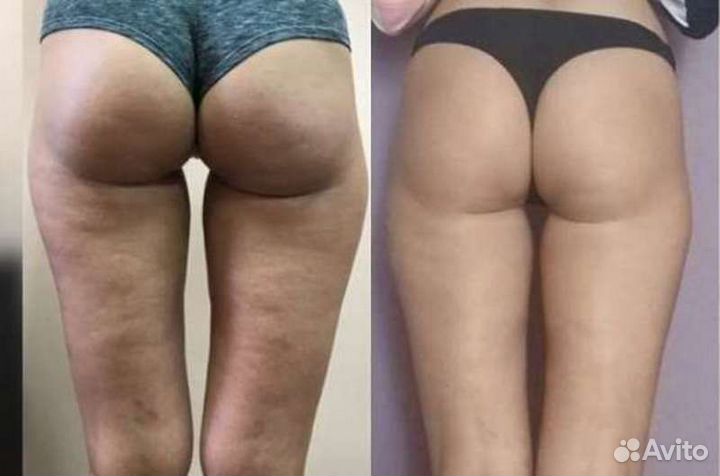 Антицеллюлитный массаж