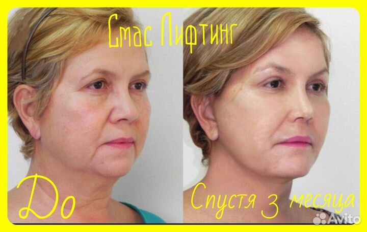 Smas-лифтинг