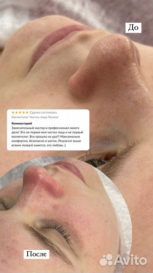 Комбинированная чистка лица