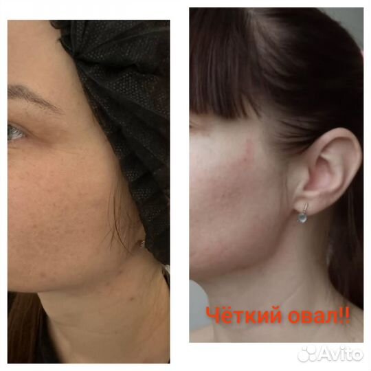 Холодная плазма