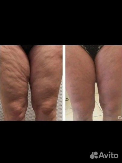Антицеллюлитный массаж коррекция фигуры
