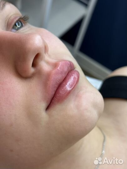 Увеличение губ