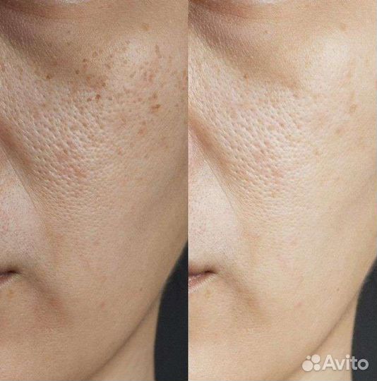 Карбоновый пилинг