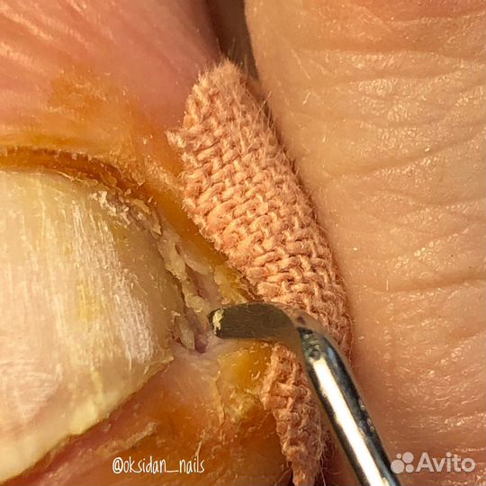 Вросшие ногти, бородавки, титановая нить, педикюр