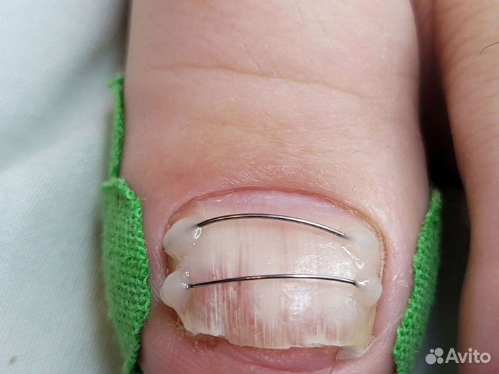 Установка титановой нити