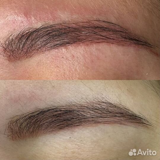 Лазерное удаление тату