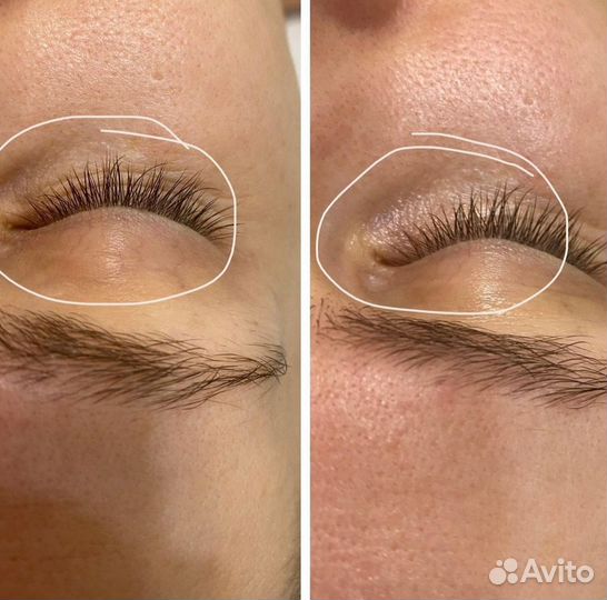 Скульптурно-буккальный массаж лица