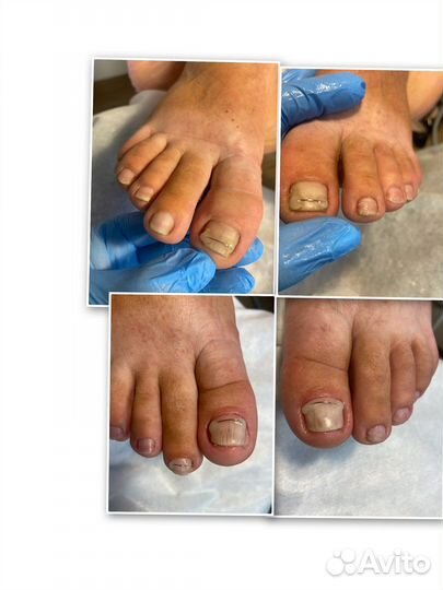 Титановые нити педикюр