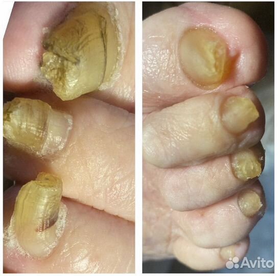 Бородавки.Мозоли.Вросшие ногти.Педикюр.Подолог