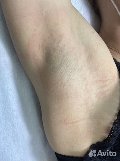 Электроэпиляция/ холодная плазма