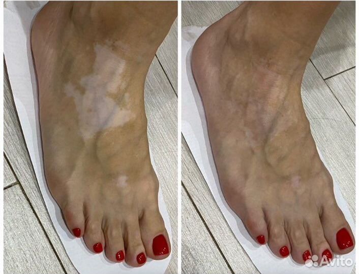 Лосьон - автозагар маскирует витилиго