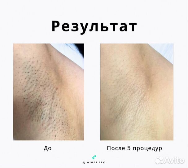 Диодный лазер люминес Макс Ван 1200 Вт