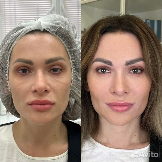 Контурная пластика лица.Full Face.Профиль Джоли