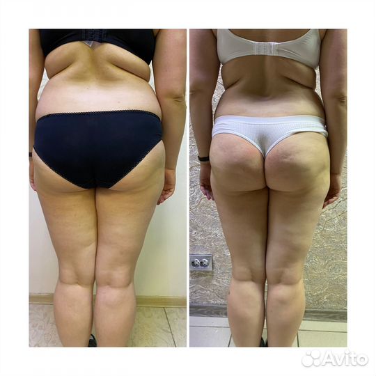 Криолиполиз, LPG, вакуумный массаж, прессотерапия