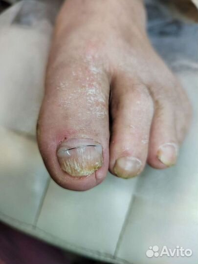 Подолог. Медицинский педикюр