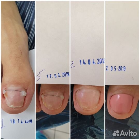 Подолог бесплатно. Коррекция вросшего ногтя