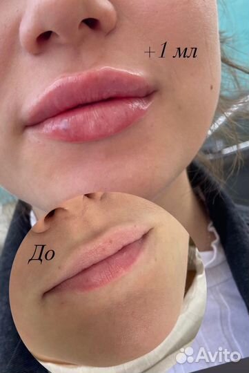 Увеличение губ/Косметолог/ ботокс