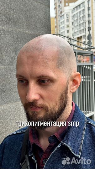 Трихопигментация SMP