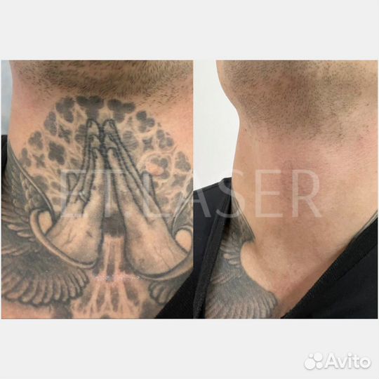 Удалить татуировку в Москве